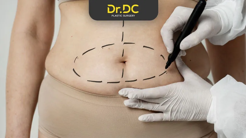 Coolsculpting vs Liposuction