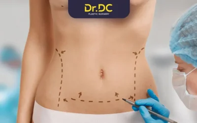 Liposuction Recovery Time: What to Expect Post-Surgery