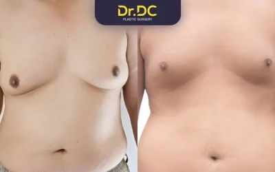 Difference between Gynecomastia and Chest Fat