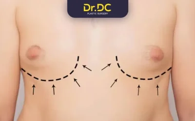 What Are the Different Gynecomastia Grades?