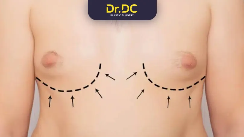 Understand the 4 grades of gynecomastia