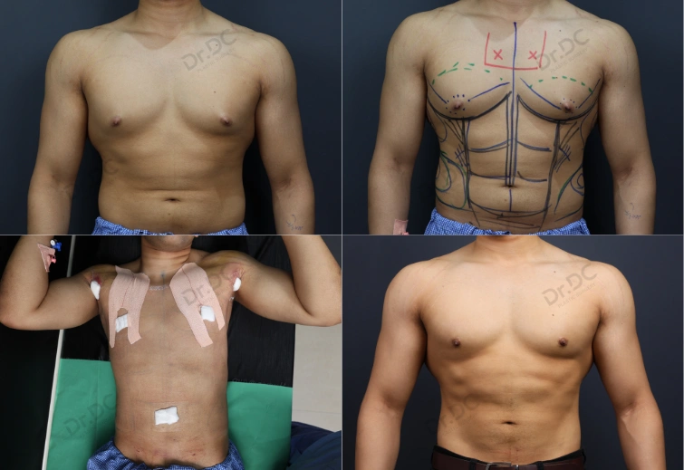 360 Lipo & Gyneomastia - Vishwajeet Liposaction Result Before After