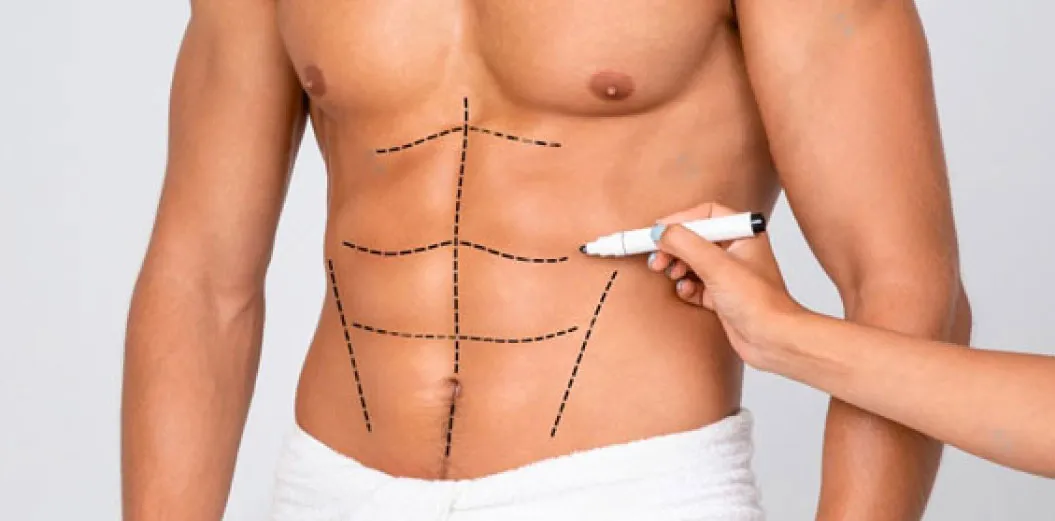 6-Pack Abs Hi Definition Liposuction 6-Pack-Abs-Hi-Definition-Liposuction
