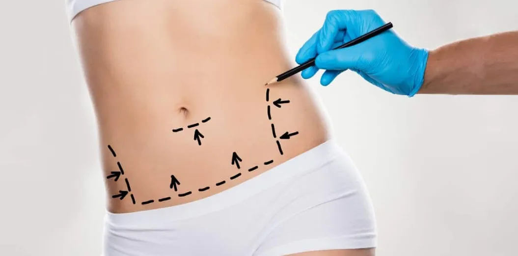 Tummy Tuck Procedure Tummy-Tuck-Procedure