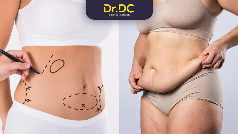 Tummy-Tuck-vs.-Liposuction--Which-Is-Right-for-You Why-is-Liposuction-the-best-choice-for-fat-reduction