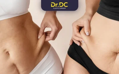 Is Liposuction Good for Obesity?