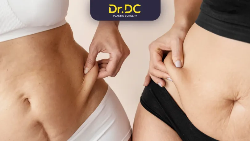 Liposuction Good for Obesity
