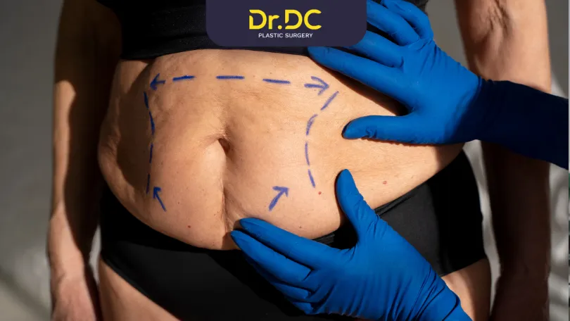 Affordable Tummy Tuck Options in India