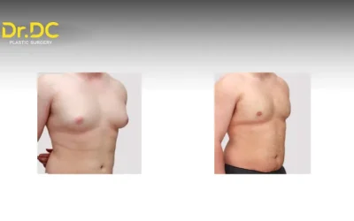 Can Gynecomastia Return After Surgery?
