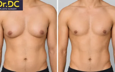 What Results Can You Expect from Gynecomastia Surgery?