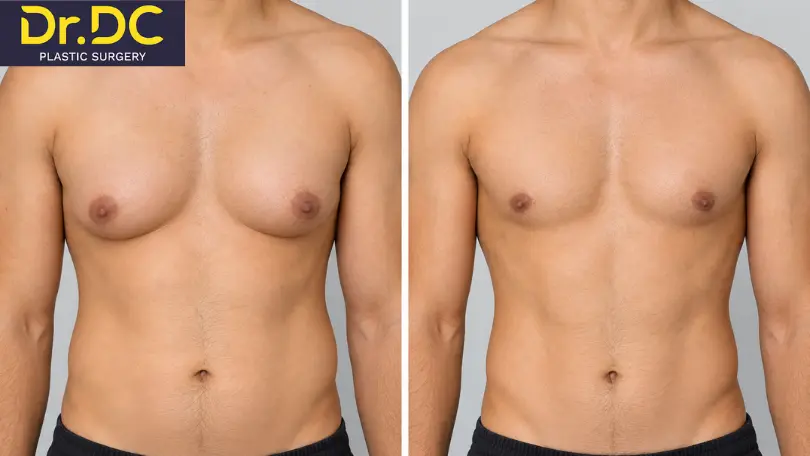What Results Can You Expect from Gynecomastia Surgery